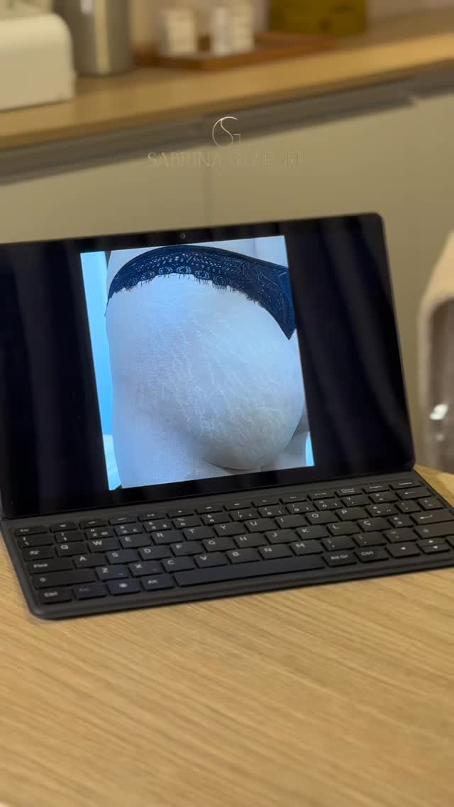 Resultado do tratamento de estrias