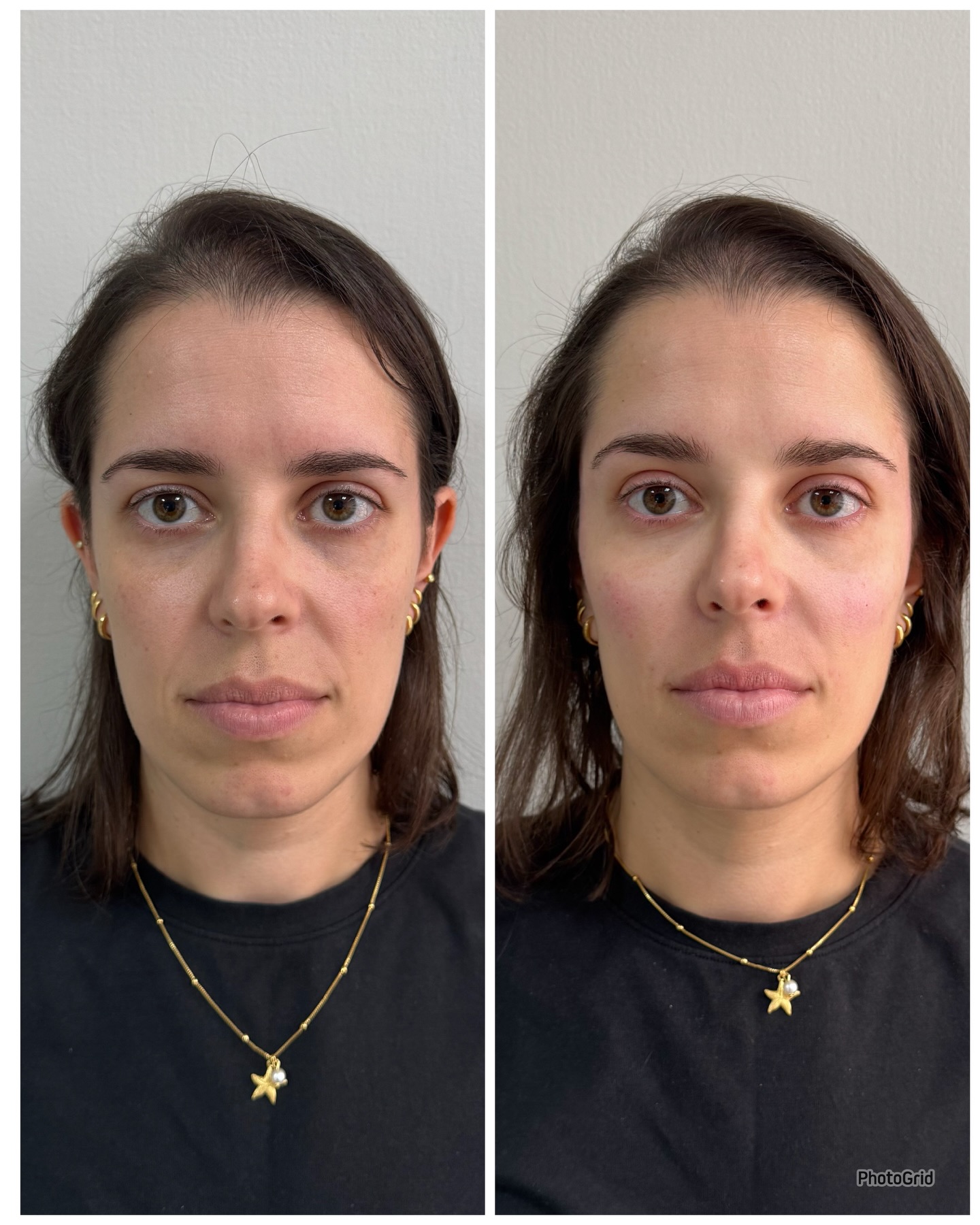 Resultado de harmonização facial antes e depois